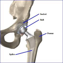 Zimmer biomet hip implant picture